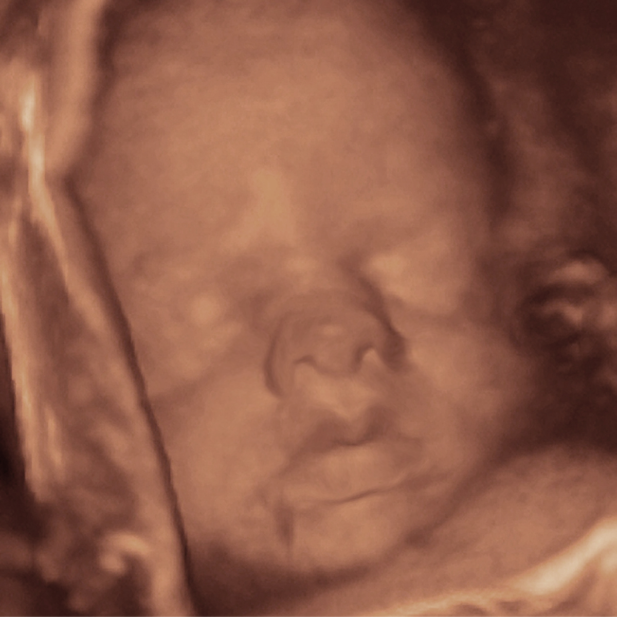 Ultrasound scan